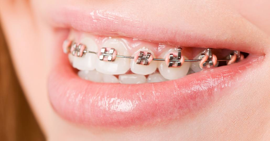 Patient with traditional metal braces at BRO