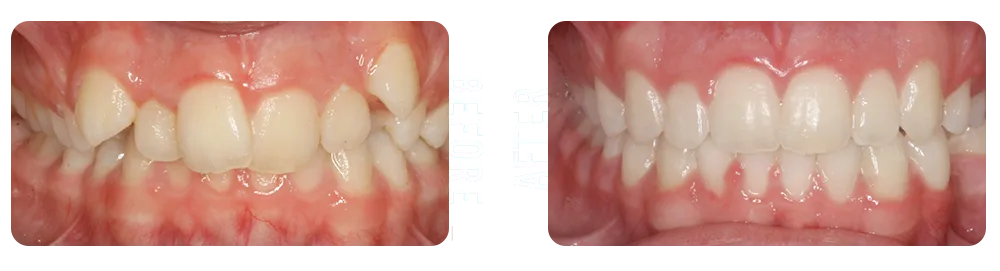 BRO-Before-After before and after