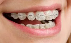 clear-braces Girl with clear orthodontic braces smiling
