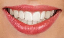 Woman with Invisalign aligner smiling for picture