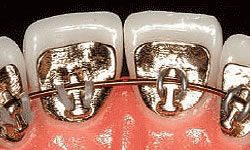Close up showing lingual braces behind patient's teeth