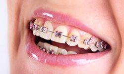 Teenager showing off her traditional metal braces