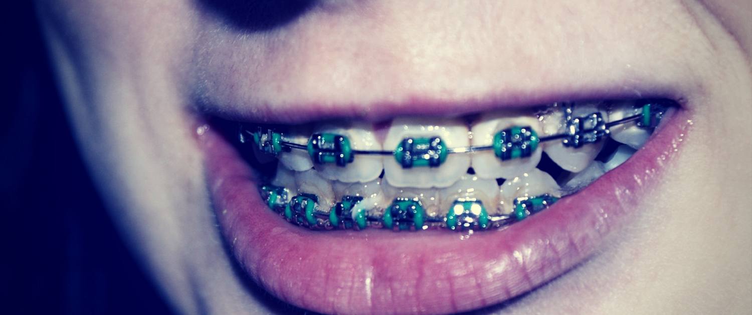 10 Facts about Braces That'll Leave a Smile on Your Face