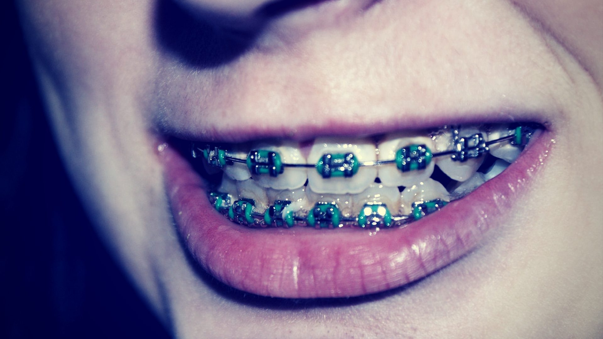 10 Facts about Braces That'll Leave a Smile on Your Face | BRO News