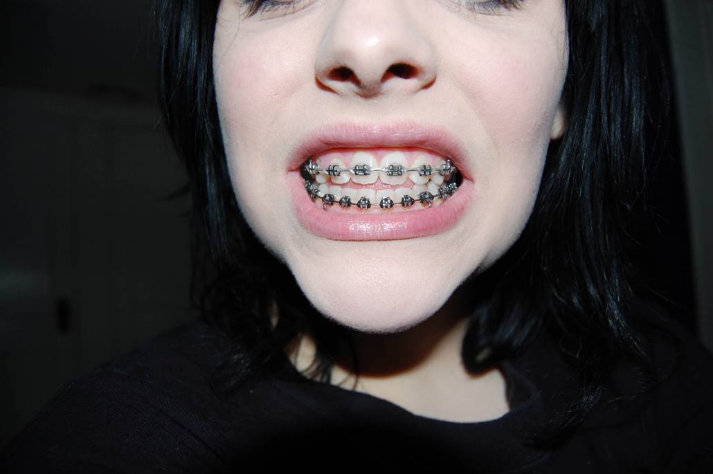 Woman shows off her adult braces