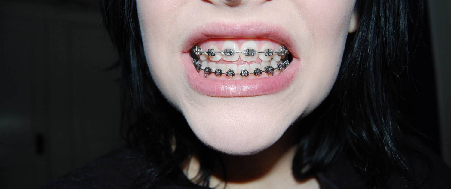 Woman shows off her adult braces