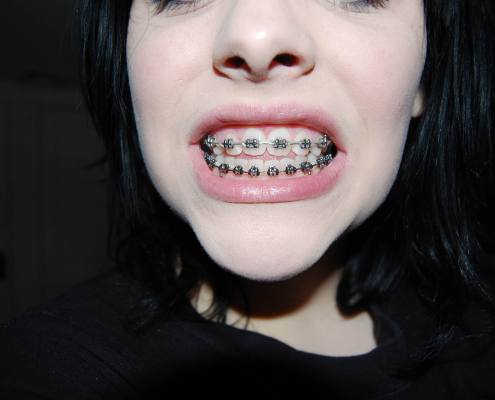 Woman shows off her adult braces