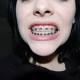 Woman shows off her adult braces