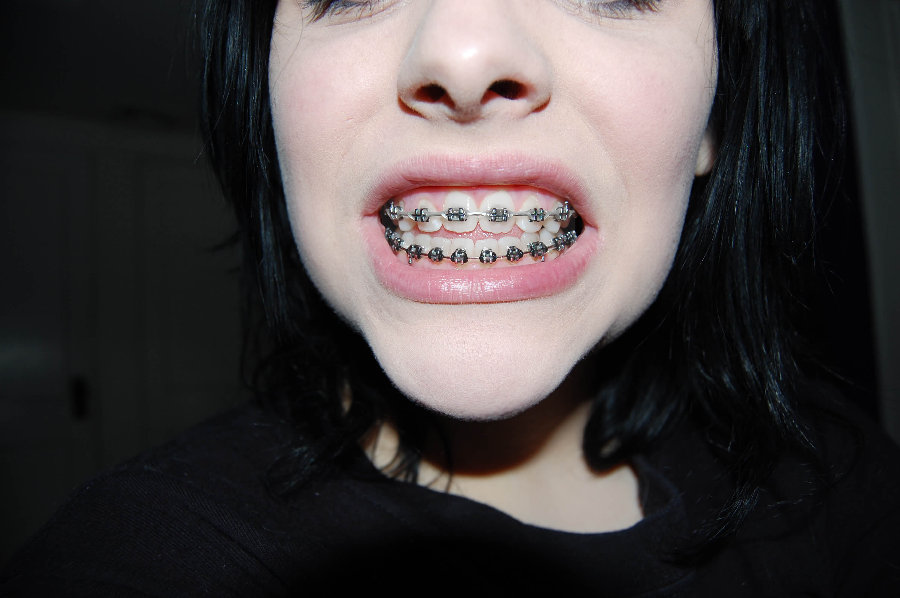 Bro S Lifestyle Guide To Adult Braces Bro Blog