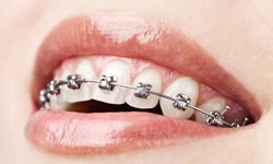 Teen with self ligating braces in Asheville