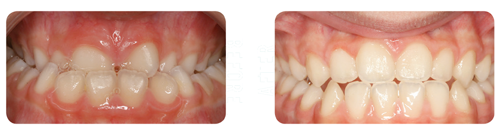 Before and after picture of orthodontic patient in Asheville