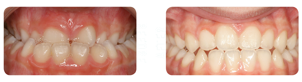 Before and after picture of orthodontic patient in Asheville