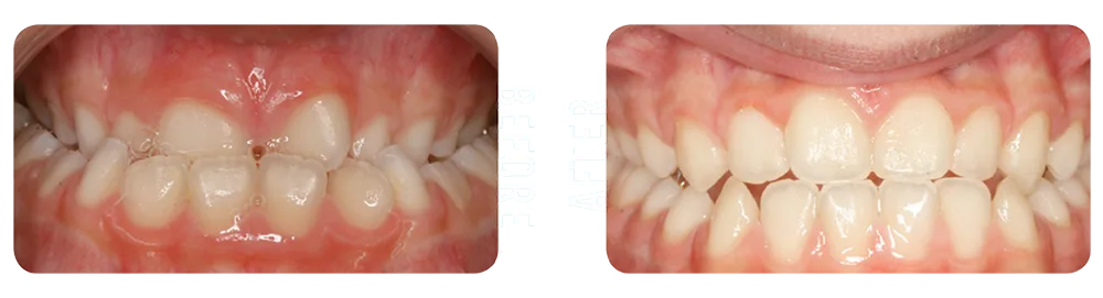 BRO-Before-After_2 Before and after picture of orthodontic patient in Asheville
