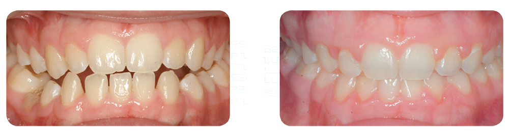 Photo showing patient's teeth before and after being treated by Blue Ridge Orthodontics