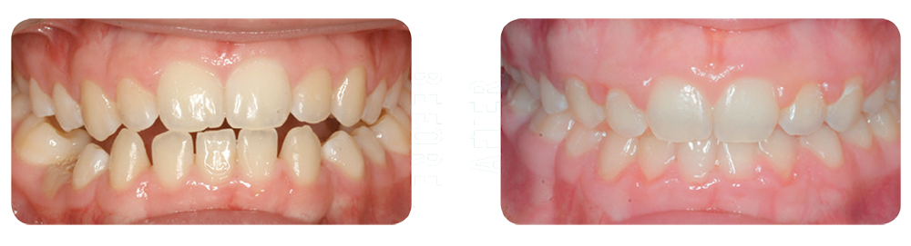 Photo showing patient's teeth before and after being treated by Blue Ridge Orthodontics