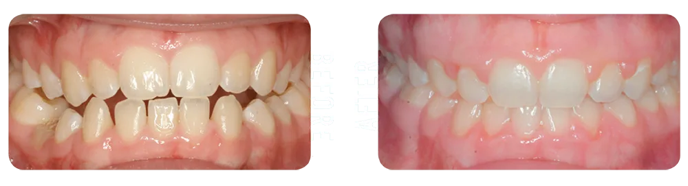 BRO-Before-After_3 Photo showing patient's teeth before and after being treated by Blue Ridge Orthodontics