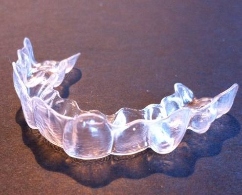 Invisalign aligner used by teenager in Asheville, NC