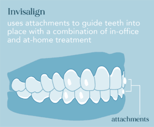 Invisalign uses attachments to guide teeth into place with a combination of in-office and at-home treatment