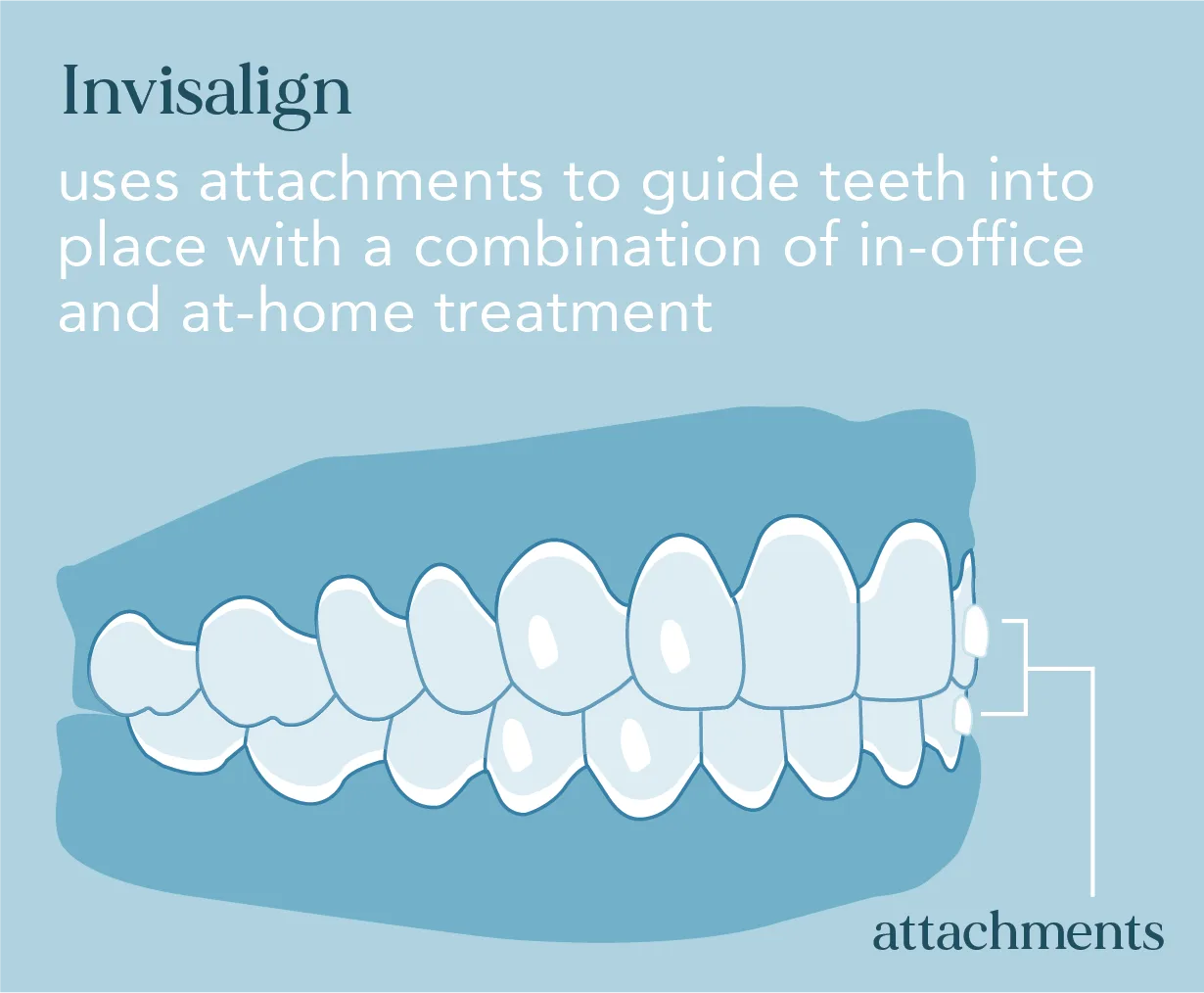 Invisalign uses attachments to guide teeth into place with a combination of in-office and at-home treatment 