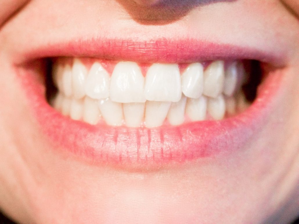 Woman with Invisalign aligners smiling in Asheville