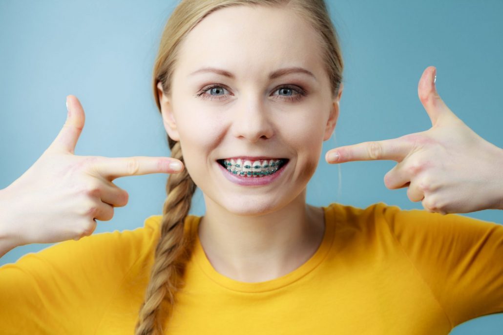 Woman who has gotten blue colored braces in Western North Carolina