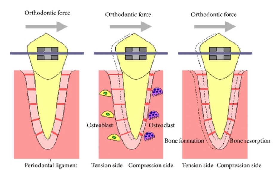 Orthodontic diagram shows how braces move teeth into alignment
