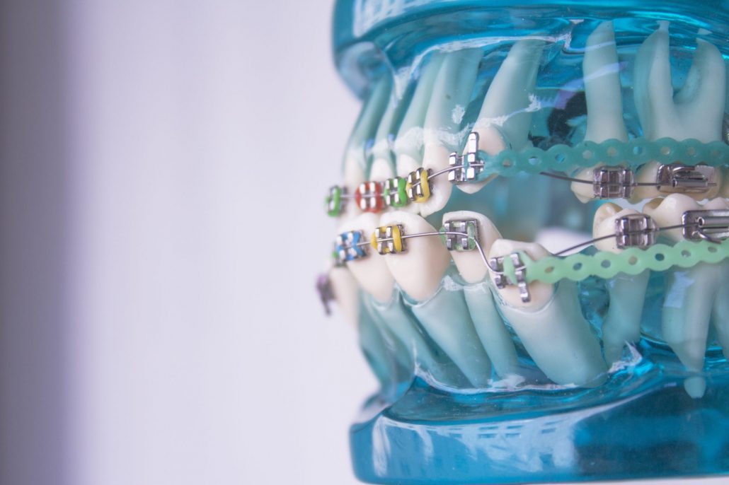 Orthodontist in North Carolina shows how braces move the teeth