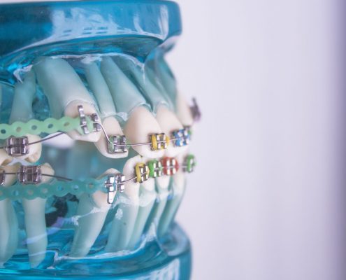 Orthodontist in North Carolina shows how braces move the teeth