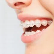 Are Ceramic Braces Right For You? Woman in Asheville gets ceramic braces at orthodontist clinic