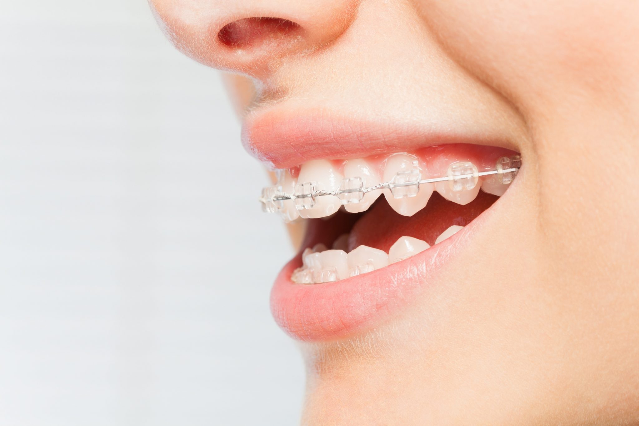 The straight scoop: Choosing between traditional braces and Invisalign «  Smiles by White