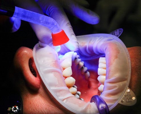 Person getting teeth whitened after braces in Asheville