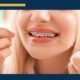 How do I Floss with Braces - young girl with braces and flossing with dental floss