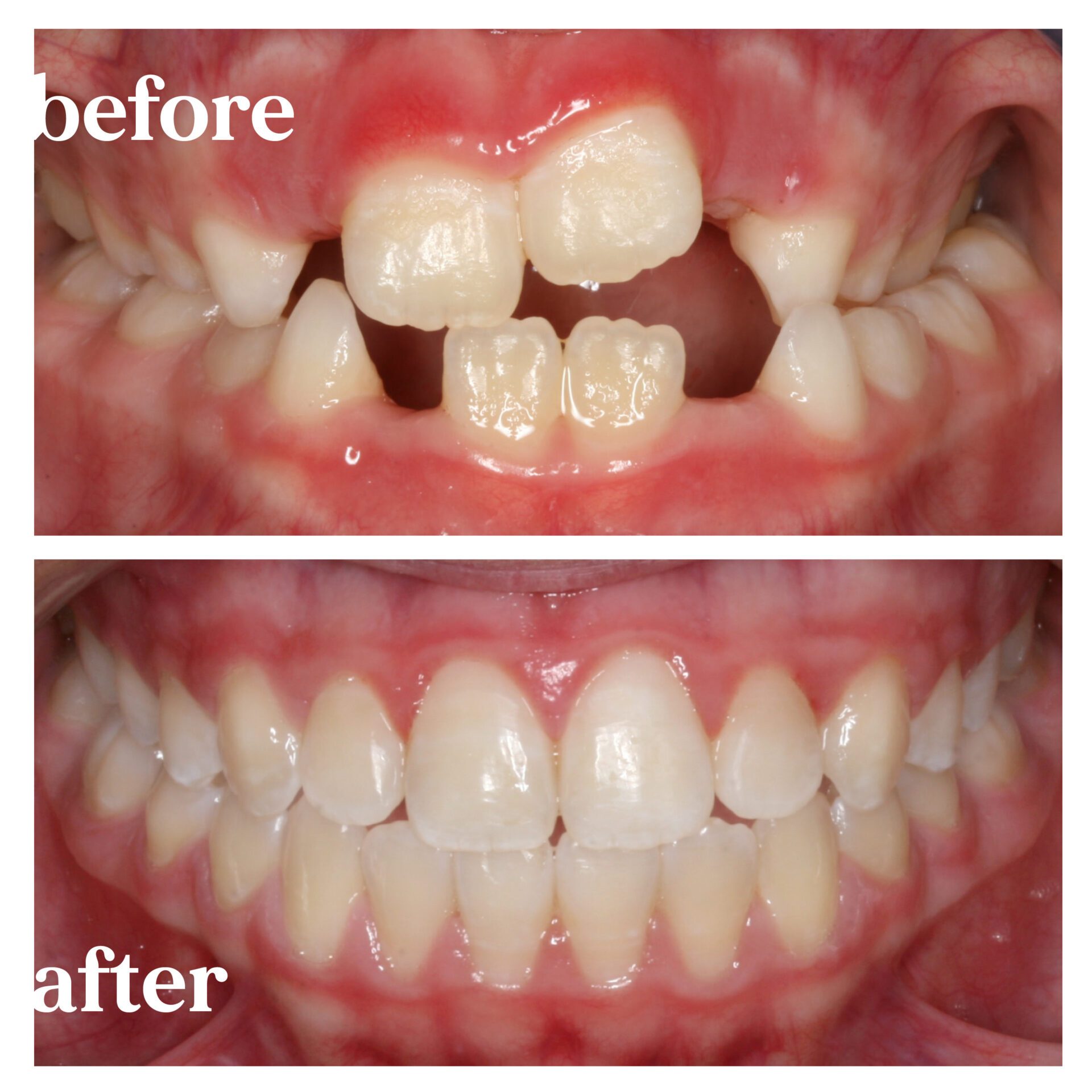before and after treatment at blue ridge orthodontics
