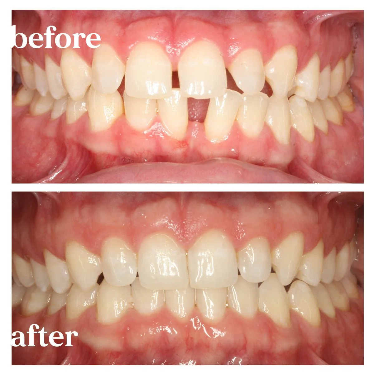 orthodontic treatment before and after photo