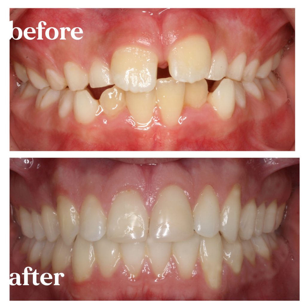 orthodontic treatment