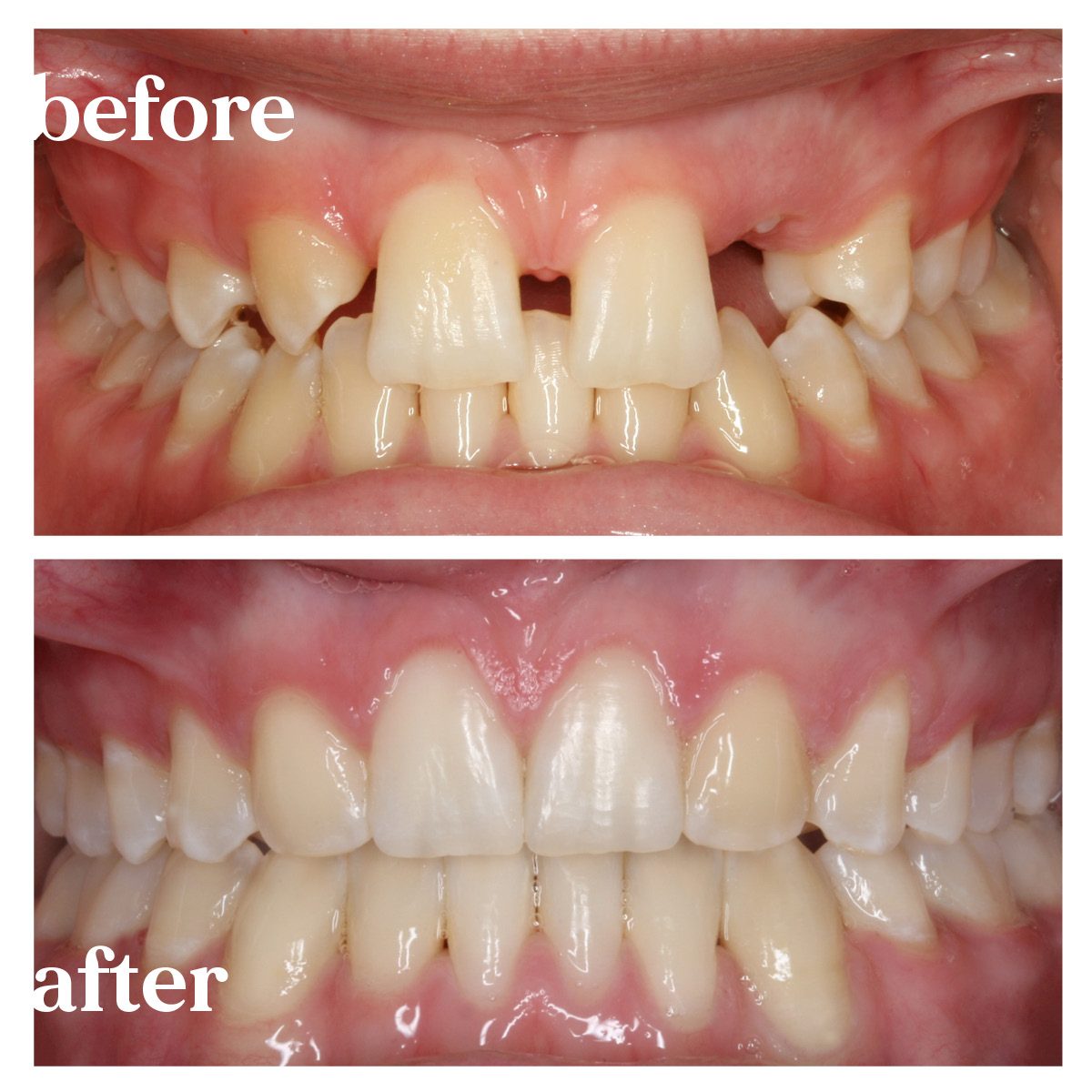 before and after orthodontic treatment