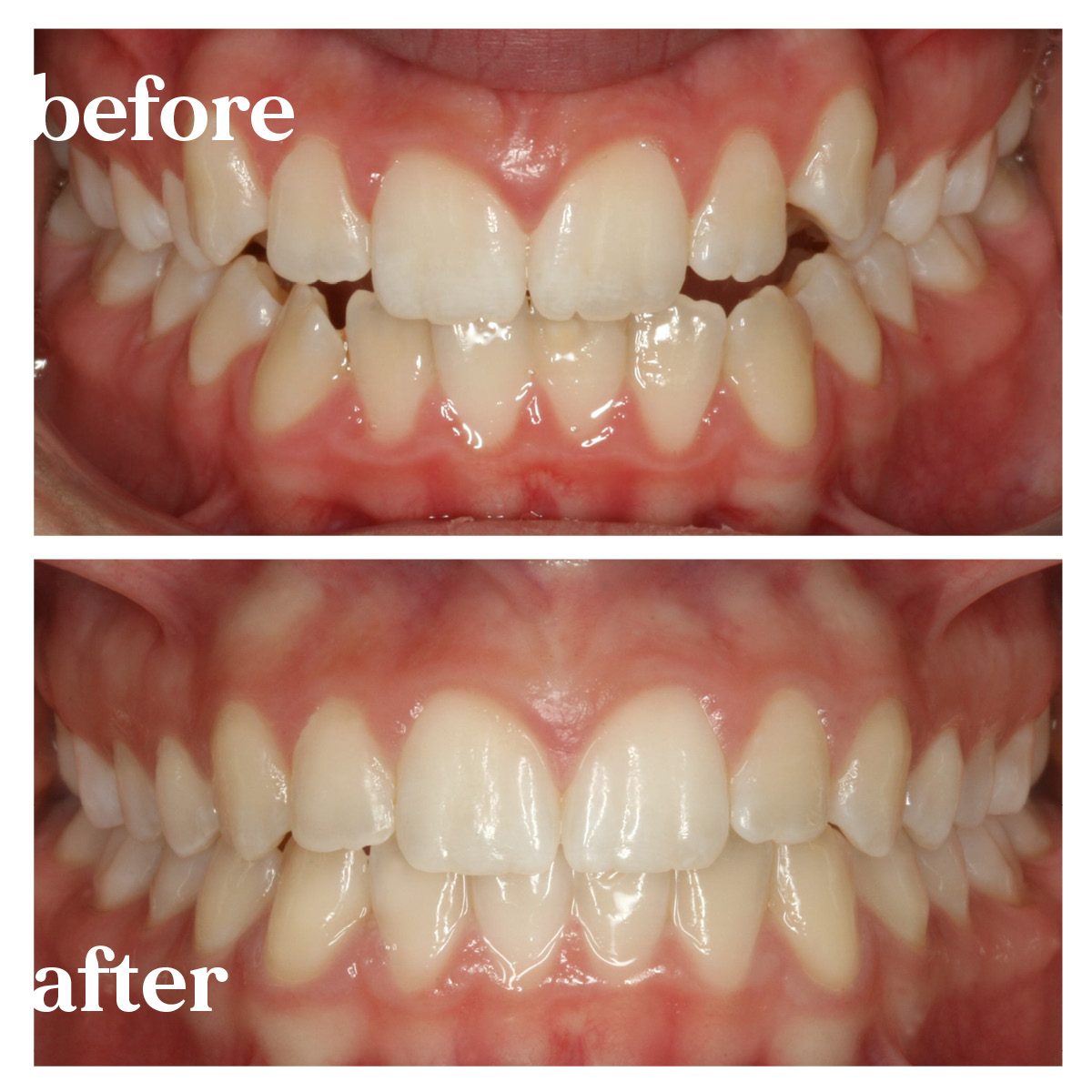 before and after treatment at blue ridge orthodontics