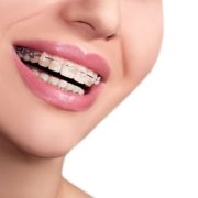 Blue Ridge Orthodontics teens get braces