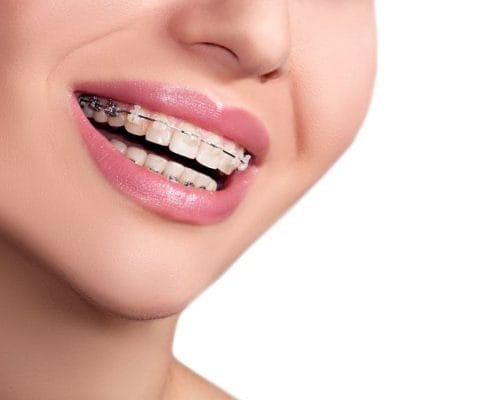 Blue Ridge Orthodontics teens get braces