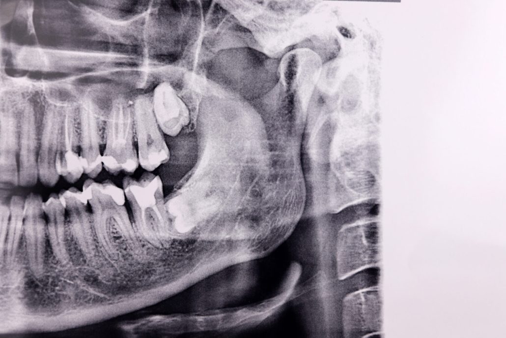 Horizontal wisdom tooth on Panoramic dental tooth X-ray examination