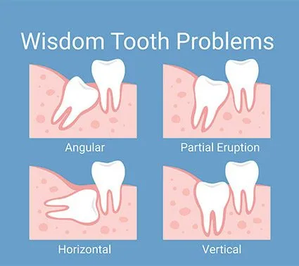 Oral Surgery General Info 1 ImpactedWisdomTeeth